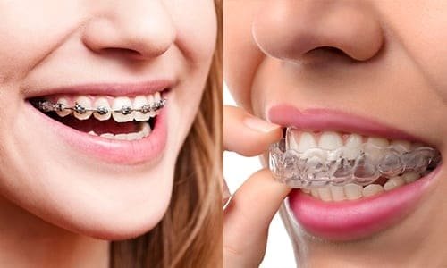 Braces & Aligners